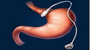 Prix de l’anneau gastrique : comment est-il remboursé?