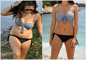remboursement liposuccion – avant et après