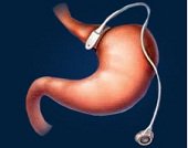 Remboursement prix anneau gastrique par mutuelle et sécu