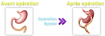 Remboursement Bypass Remboursement Bypass