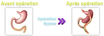 Remboursement Bypass